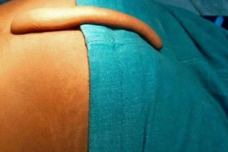 В Баку парню удалили 18-сантиметровый "хвост"