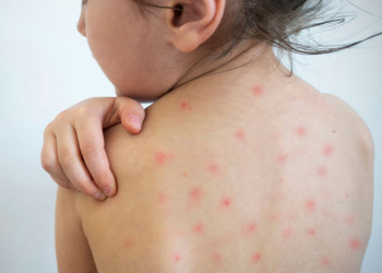 Вспышка кори в Казахстане 3 Вспышка кори в Казахстане