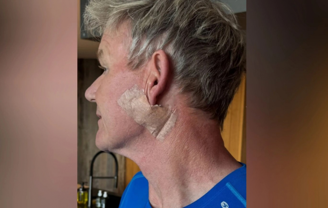 У легендарного шеф-повара выявили рак кожи