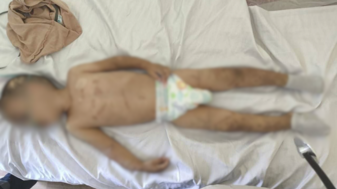 Ребёнку в Баку удалили часть кости черепа из-за истязаний родителей-извергов